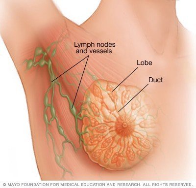 what is breast cancer